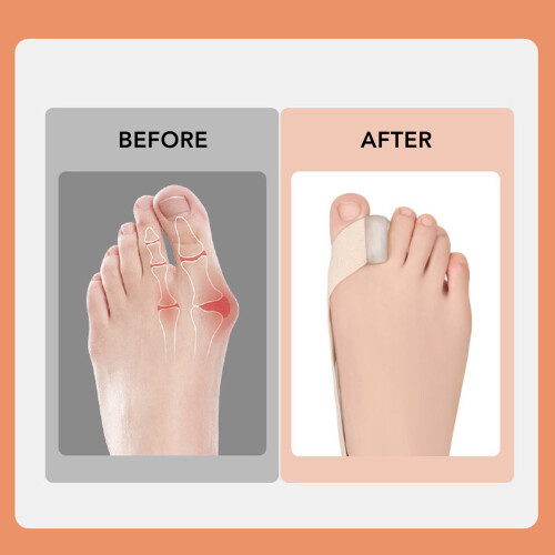 Hallux-Valgus-Gürtel Elastisch Hautfarbe L 40-45 2