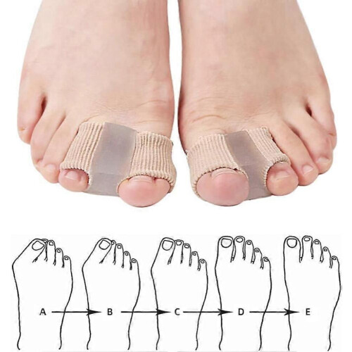 Toe Separator,Toe Corrector,2PCS Overlapping Toe Separators,Toe Separators,Large Toe Spacer,Toe Separator,Toe Separator,Hallux Valgus Toe Se 2