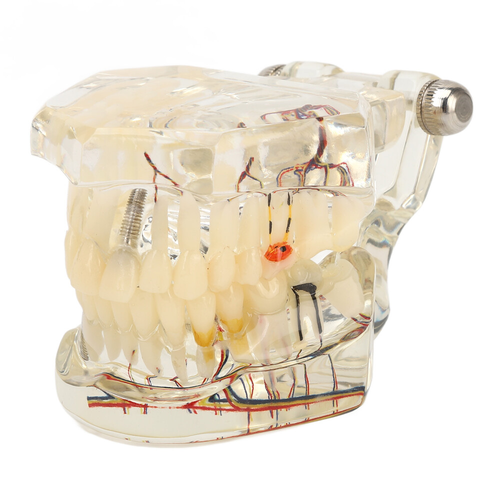 Pathology Teaching Model Removable Parts Dental Implant Models Adult Typodont Demonstration Transparent Disease Pathology Teeth Teaching Model For St