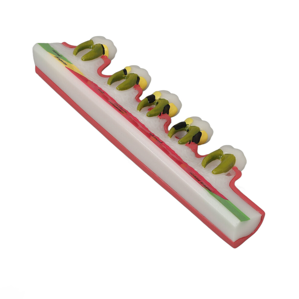 Dental Periodontal Disease Model, Resin, Multi-Stage Disease Display