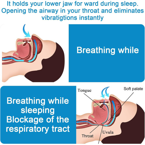 AntiSnoring and Teeth Grinding Guard for Peaceful Sleep 1