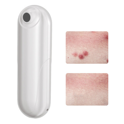 USB Rechargeable Mosquito Bite Relief Tool for Bug and Wasp Sting Itching 1