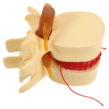 Khaki PVC Herniated Disc Spine Model Enlarged for Anatomy Study