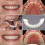 Veneers for Missing Teeth  and Bottom, Instant Smile Makeover Fake Teeth Dentures 2