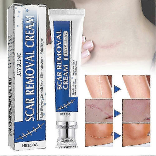 (2pcs)Acnes Scars Removal Cream Effectiveness Non-irritating Cream For Face & Body 1
