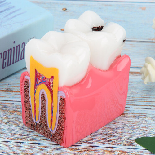 Dental Caries Tooth Model With Imported Resin Material, Decay Teeth Comparative Study Model For Practical Dental Studies And Research 2