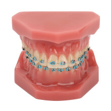 Tandmodel, demonstratiemodel voor orale orthodontie met keramische en metalen beugels voor gedetailleerde studie en verbeterd patiëntenadvies.