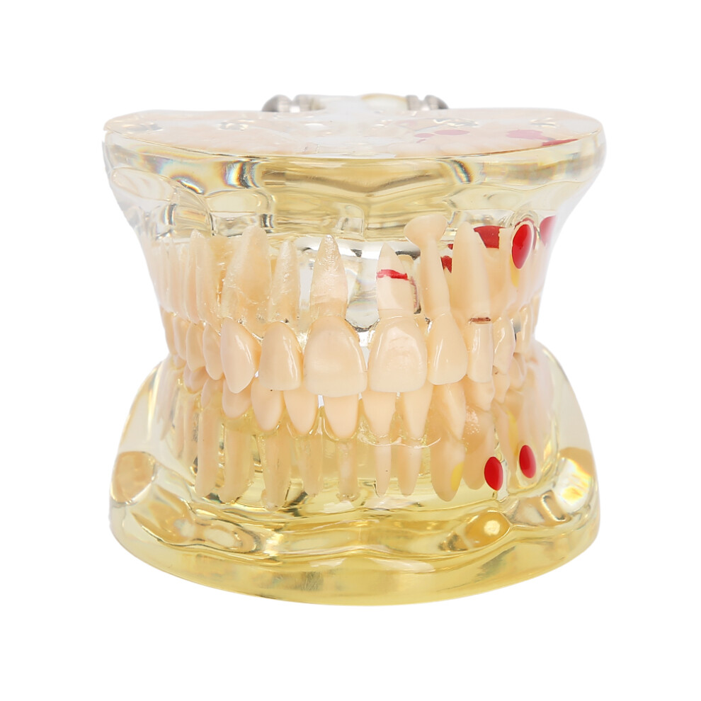 Patient Education Tool, Dental Teaching Model Featuring Removable Tooth For Clear Demonstrations