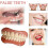 Upper/lower dentures perfect smile veneer dentures 1
