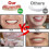 Upper/lower dentures perfect smile veneer dentures 2