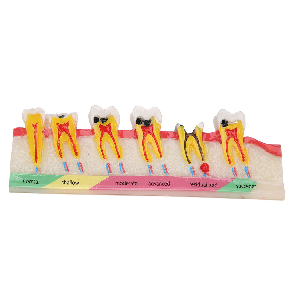 Teaching Model For Dental Periodontal Disease, Clear Representation Of Gingivitis To Advanced Periodontitis, High-Quality Resin Ensures Durability