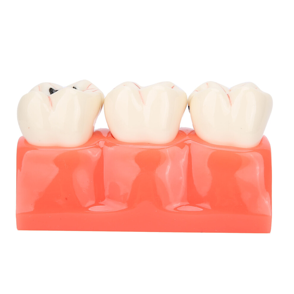 Professional Dental Teaching Equipment, Clear Morphological Structure Resin Teeth Model, Simulation Appearance Ideal For Classroom Demonstrations