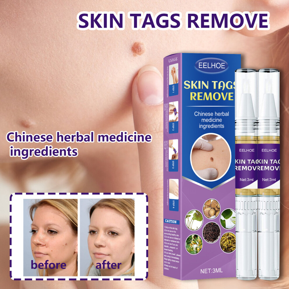 Wart Eradicator Solution, Precision-Targeted Approach For All Skin Types, Natural And Potent Results From Exclusive Formula, 5Pcs For Nightclubs