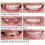 Smile Snap On False Teeth Upper Lower Dental Veneers Dentures Tooth Cover Setyj51-3 2