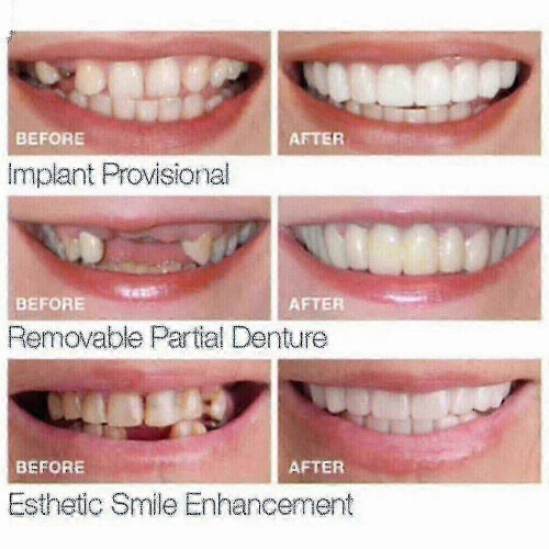 Smile Snap On False Teeth Upper Lower Dental Veneers Dentures Tooth Cover Setyj51-3 1