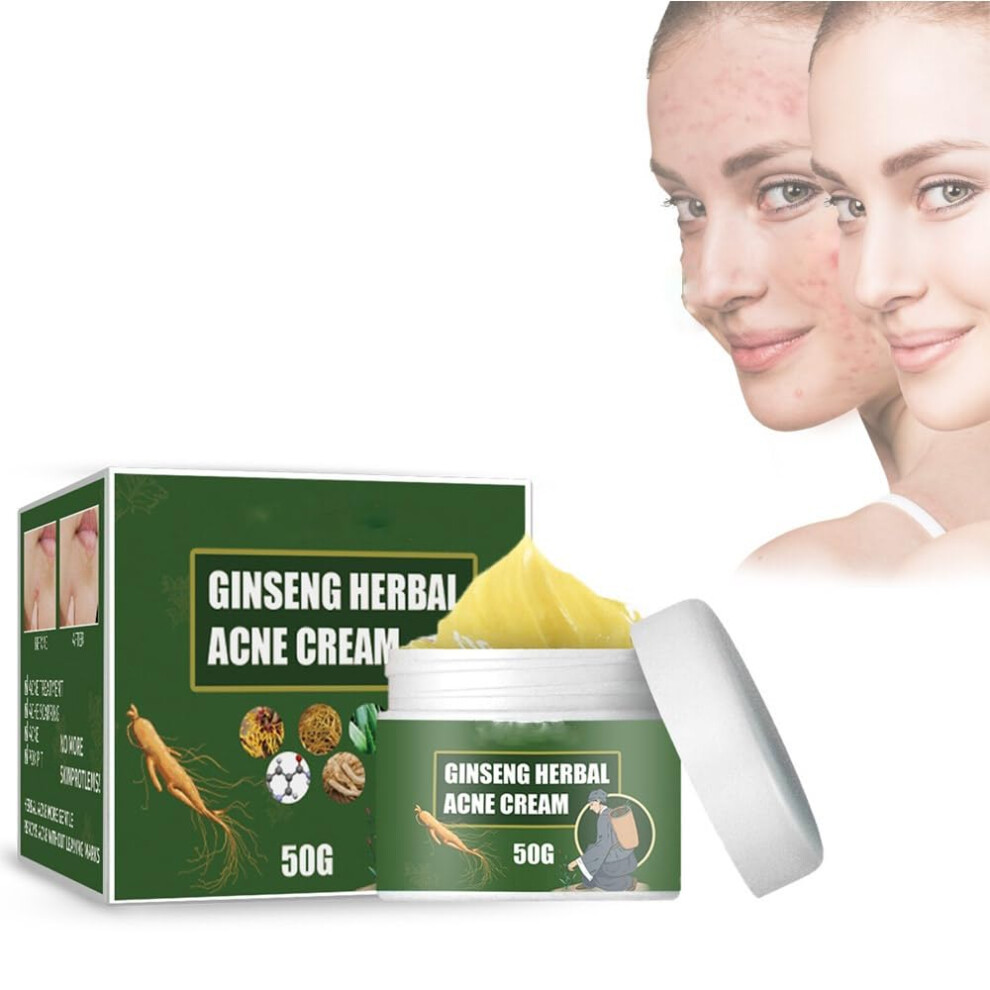 Cream/Dark Acne Treatment 50G Herbal Formula For Clear Skin, Pimples And Spot Removal