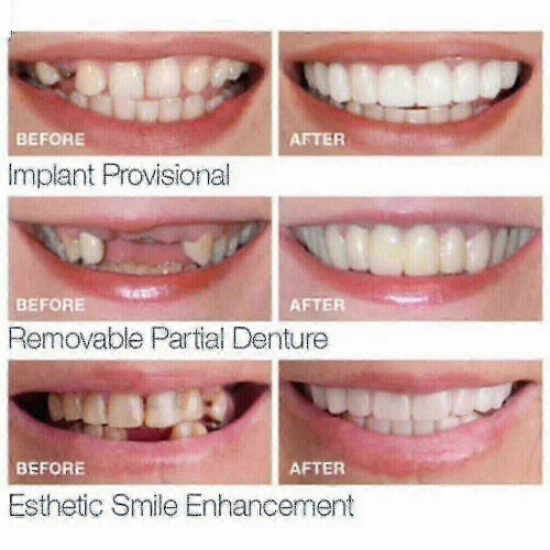 Smile Snap On False Teeth Upper Lower Dental Veneers Dentures Tooth Cover Set 1