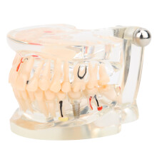 Modelos dentales Ultrassist transparentes con simulación de lesiones dentales. Material didáctico para uso profesional en el asesoramiento al