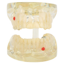 Modelo de dientes para demostración patológica, modelo de dientes para implantes dentales, diseño transparente, modelo de aprendizaje dental con