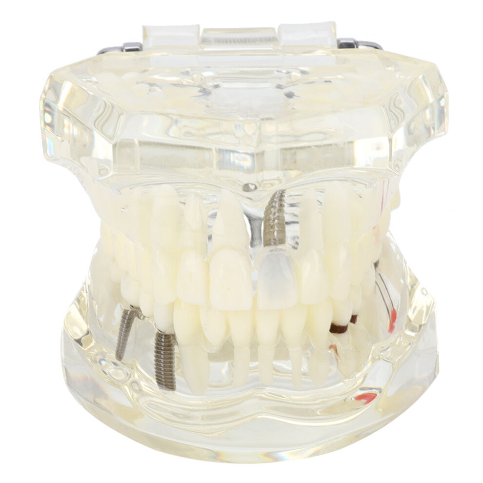 Dental Implant Study Model, Transparent Teeth Structure Visualization Tool For Educational Demonstration And Laboratory Research With Detachable 9482726472674