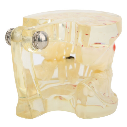 Dental Learning Model Transparent Design Pathological Demonstration Teeth Model with Detachable Components Visual Understanding for Dentist Standard 2