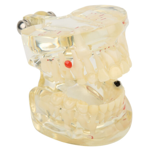 Dental Learning Model Transparent Design Pathological Demonstration Teeth Model with Detachable Components Visual Understanding for Dentist Standard 1