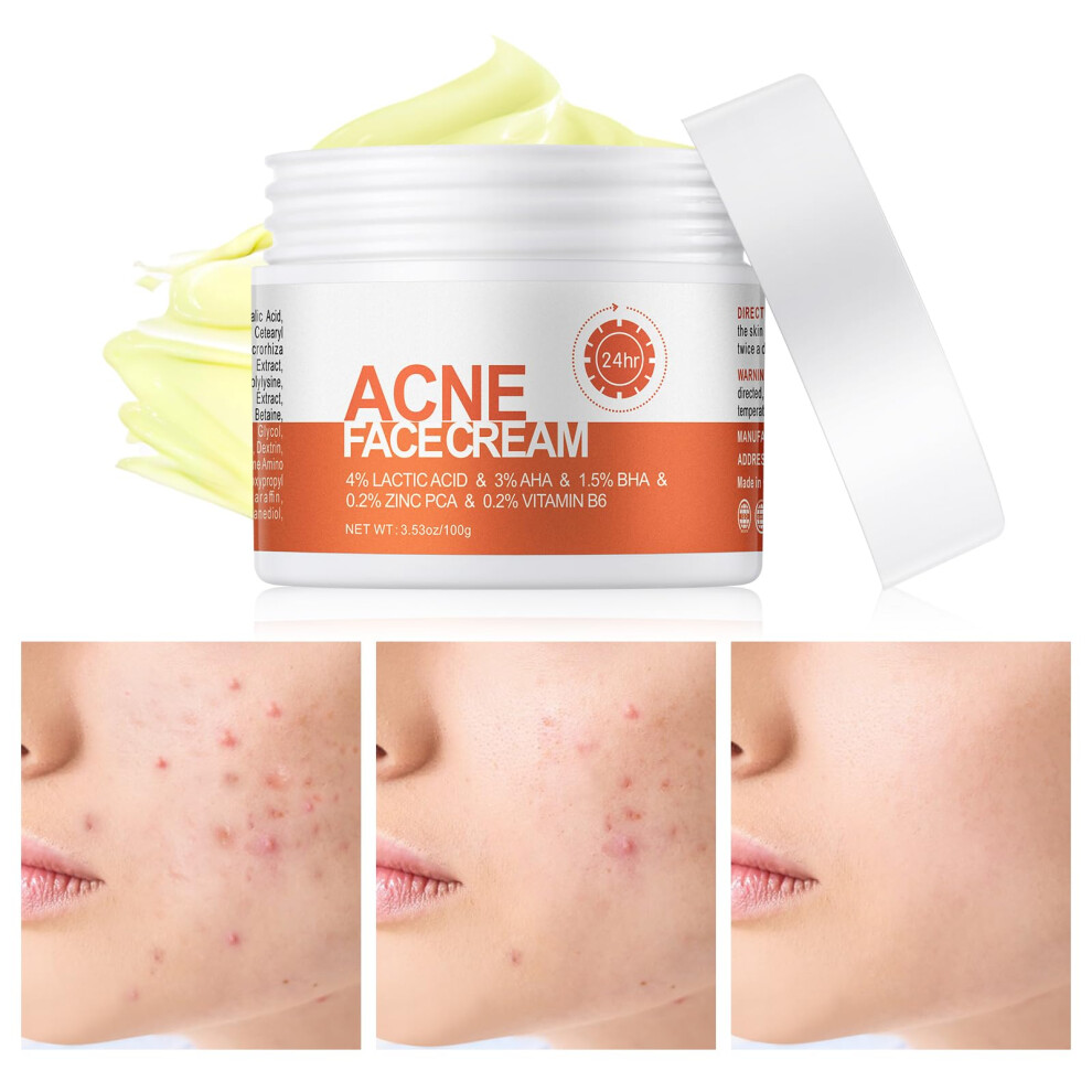 Cream Acne Treatment With Salicylic Acid For Face And Body, Spot Treatment And Oilcontrol Moisturizer