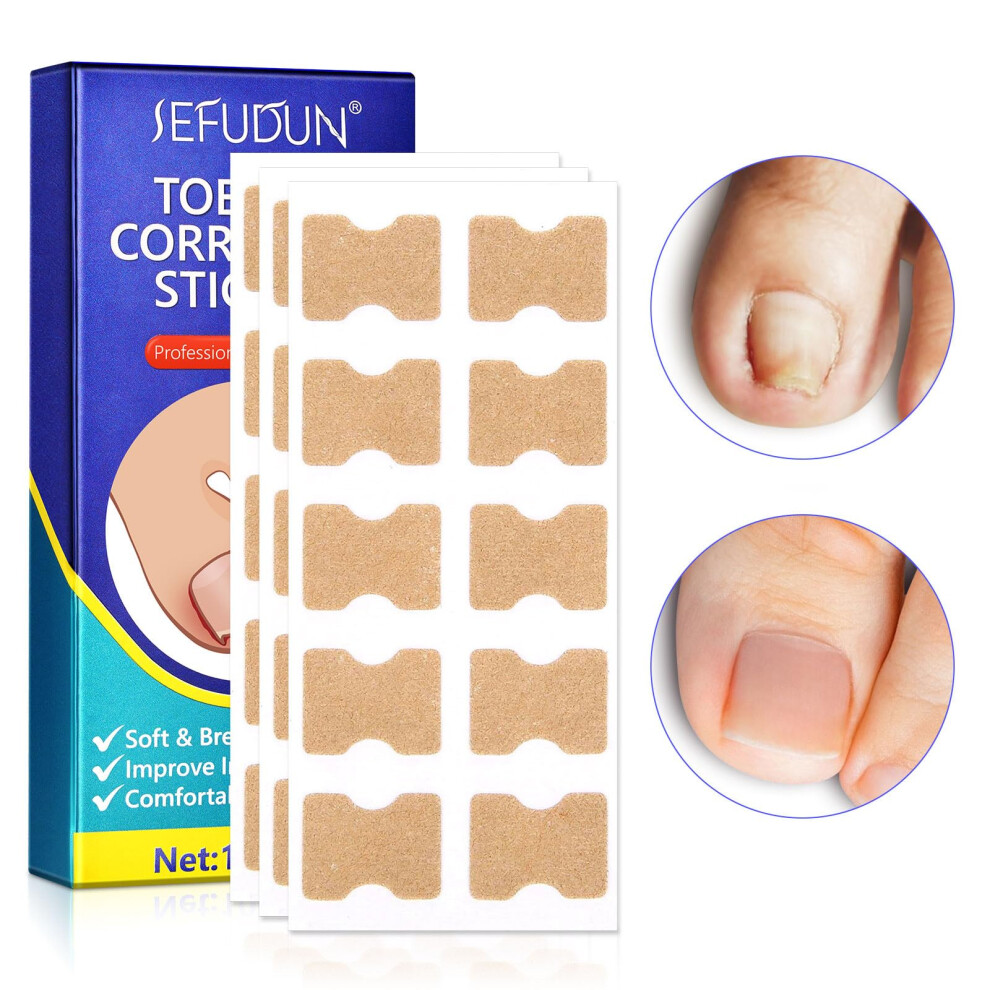 Ingrown Toenail Treatment Kit with Painless Corrector Strips, 100 Pcs Long Lasting Patches