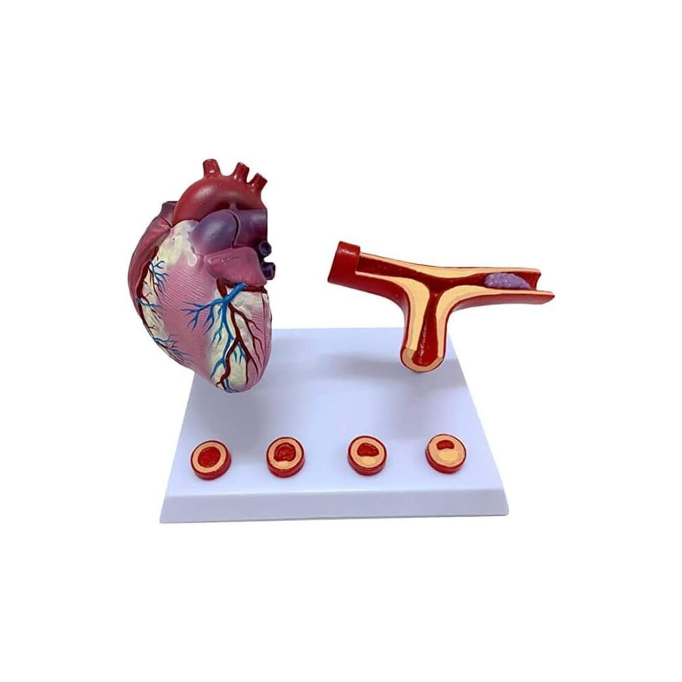 Anatomical Heart Model Life Size with Removable Bypass for Coronary Artery and Thrombosis Study