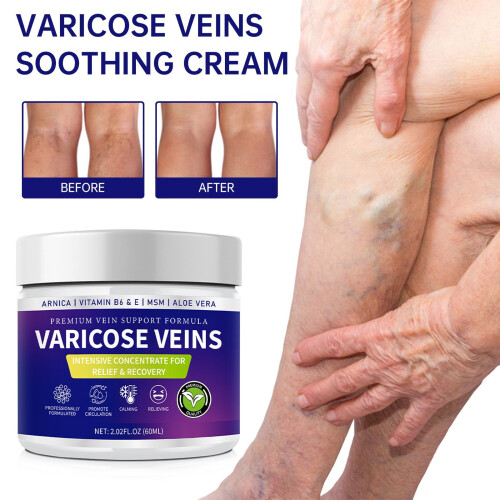 2PCS Varicose Veins Care To Bulging Veins Moisturizing 2