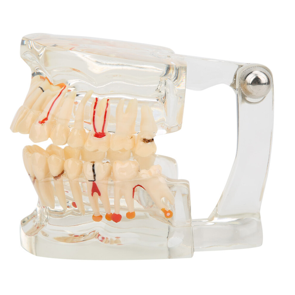 Transparent Pathological Teeth Model Dental Teaching Model With Detachable Components Simulates Oral Problems For Treatment Planning And Patient 9175034386923