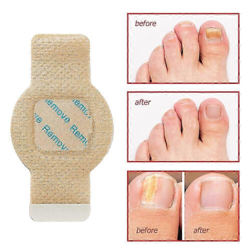 Fungus Patch Waterproof Nail Repair Patches Αυτοκόλλητο διόρθωσης νυχιών για αποχρωματισμέ 1