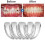 Teeth Retainer Tooth Aligners-3-σε-1 Δίσκοι για ίσιωμα και διόρθωση δοντιών 3