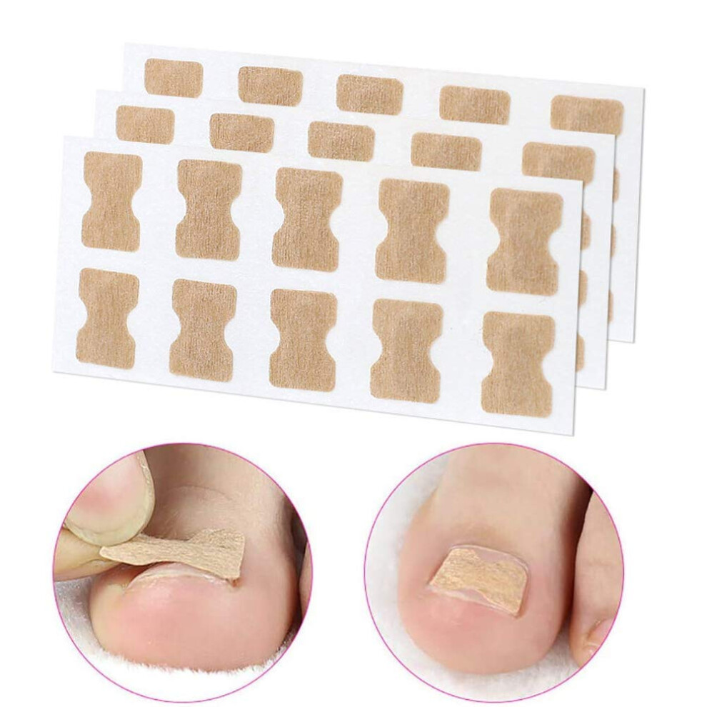 Ingrown Toenail Correction Patch Waterproof Breathable SelfAdhesive Sticker for Men and Women 3pcs