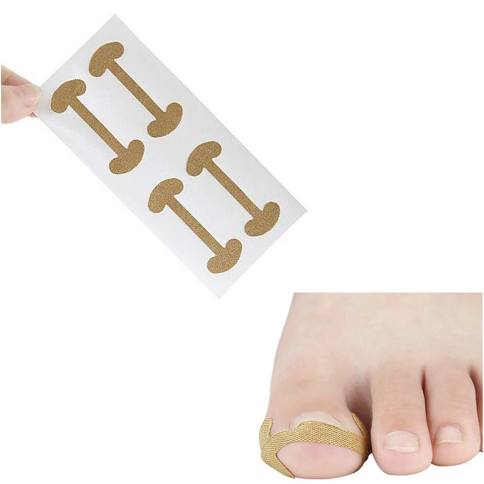 Ingrown Toenail Correction Patch 20PCS Breathable Cotton Brace for Pain Relief and Nail Shape