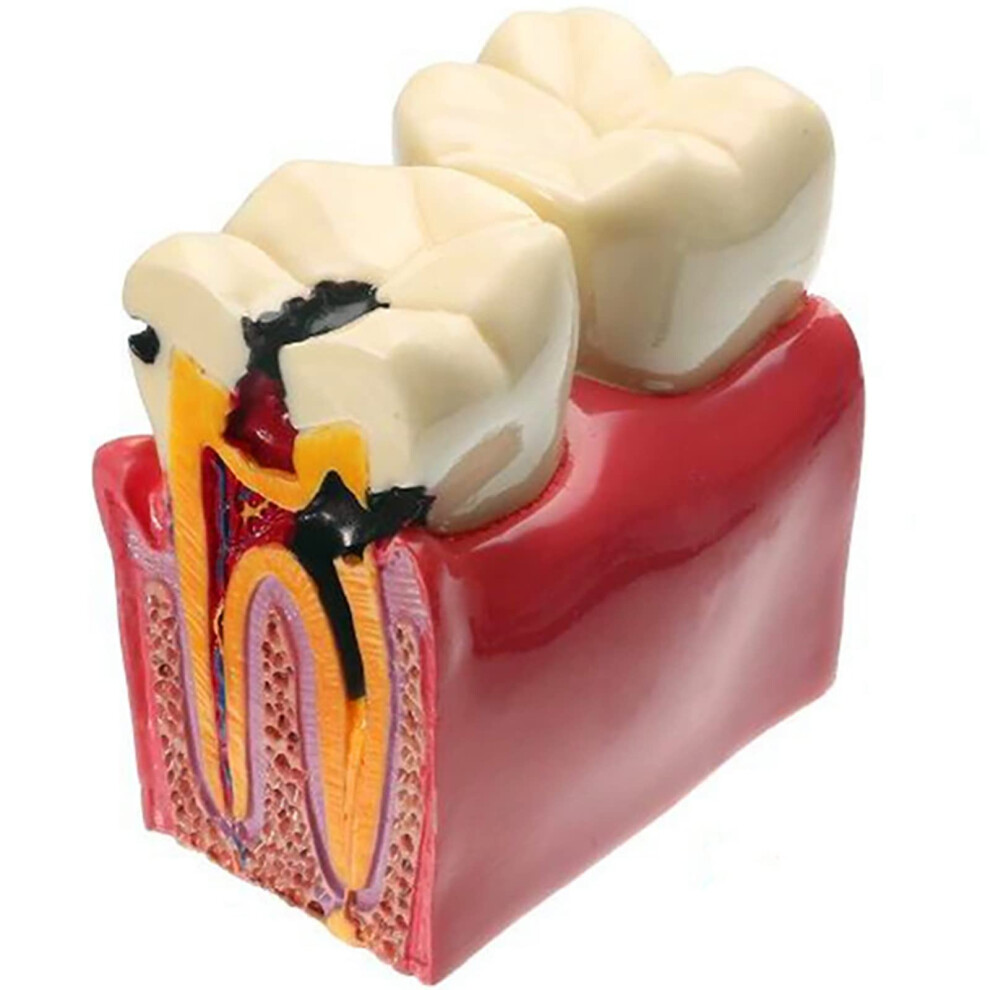 Dental Caries Teaching Model 6X Magnification Resin Tooth Decay Demo for Dentist Patient Communication