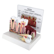 Dental Tooth Model with Detachable Oversized Anatomy and Realistic Pathologies for Patient Education