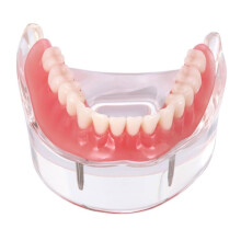 Dental Implant Teaching Model with Transparent Anatomy Display and Overdenture Training Features