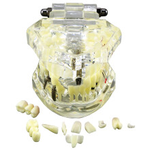 Dental Typodont Model M2001 Clear for Implant Restoration Bridge Study and Oral Pathology Training