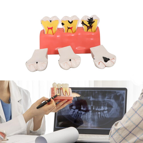Dental Teaching Model with Realistic Decay Simulation, Removable Resin Tooth for Classroom 2