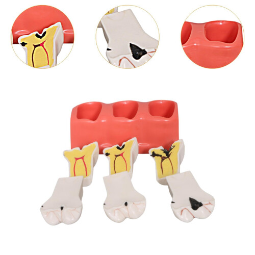 Dental Teaching Model with Realistic Decay Simulation, Removable Resin Tooth for Classroom 1