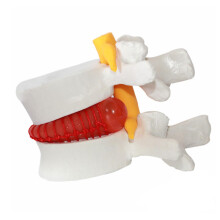 Lumbar Spine Model with Herniated Disc, Enlarged 1.5x Scale, Flexible PVC, L4L5 Anatomy Teaching
