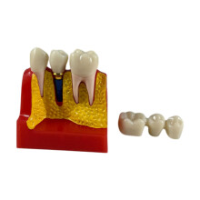 Dental Teaching Model 4x Magnified Resin Tooth Anatomy for Education and Training Display