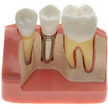 Dental Implant Model with Removable Crown, 4Fold Tooth Anatomy and Bridge Restoration Demo