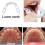 Fake Teeth Temporary Veneers for Missing Teeth, Adjustable Secure Fit,  and Bottom Set, 2 Pairs 4