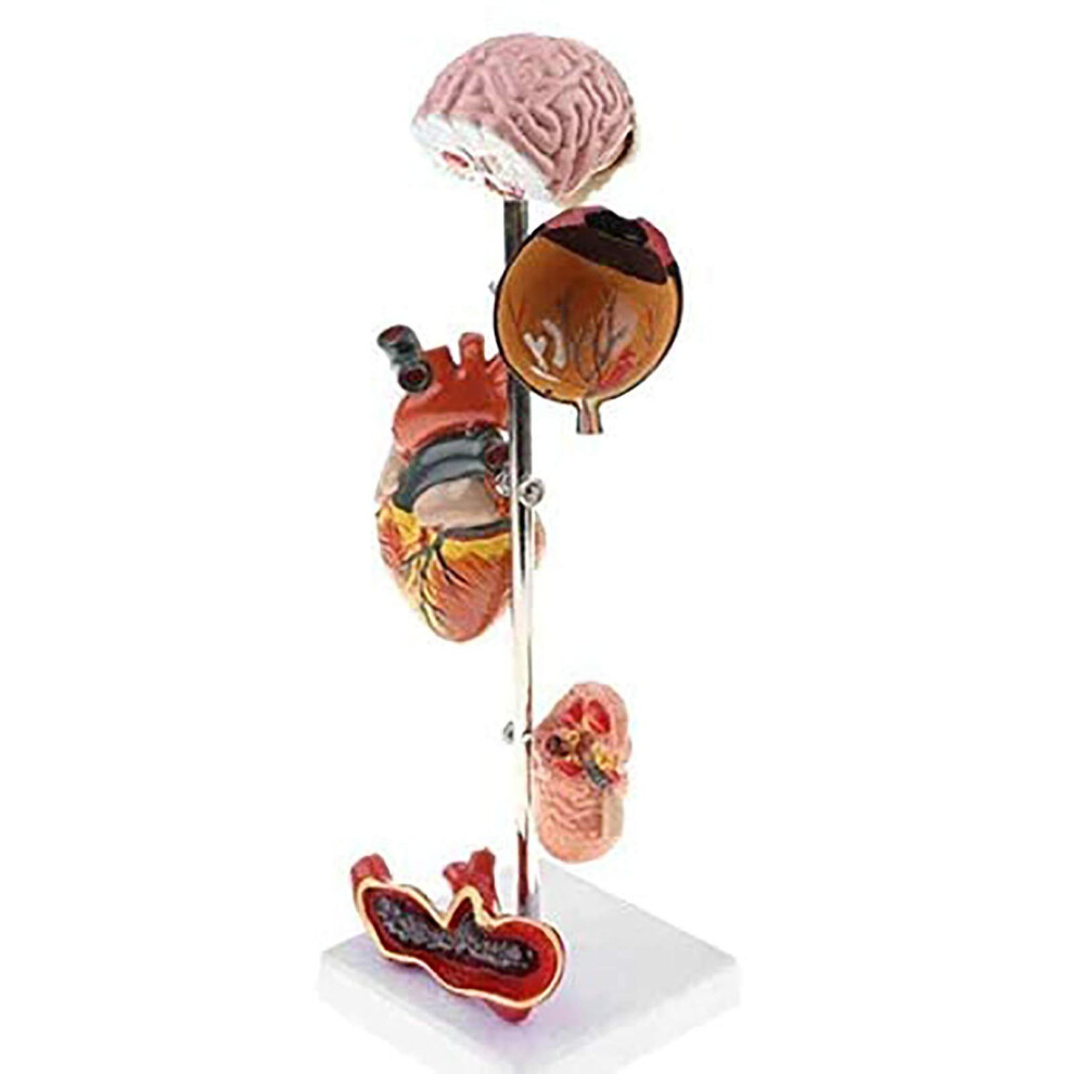 Anatomical Hypertension Model with Detachable Parts and Clear Human Organ Pathology Display