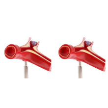 2X Menselijke Atherosclerose Cardiovasculair Model Vasculair Anatomiemodel Tak Atherosclerose Lesmateriaal