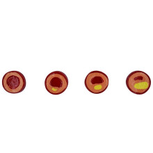 2X Human Atherosclerosis Cardiovascular Model Vascular Anatomy Model Branch Atherosclerosis Teaching Supplies