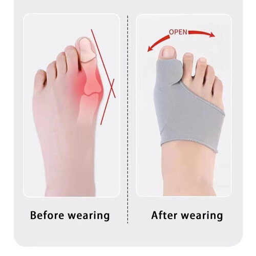 Peak Bunion Corrector2025 - Αναπνέουσα ανακούφιση από τον κάλο ημέρας και νύχτας για γυναίκες 1