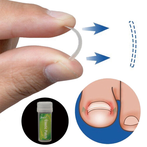 Ingegroeide teennagelcorrector van plastic, 10 stuks 2